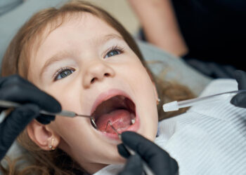 Ruperea dinților de lapte la copii – cauze, simptome și tratamente sigure pentru dentiția temporară
